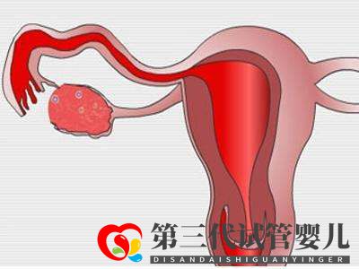 子宮肌瘤做俄羅斯試管嬰兒的成功率高嗎？(圖2)