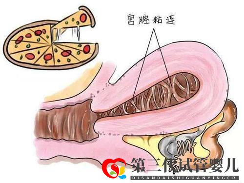 子宮粘連可以做試管嬰兒嗎？成功率高不高？(圖2)