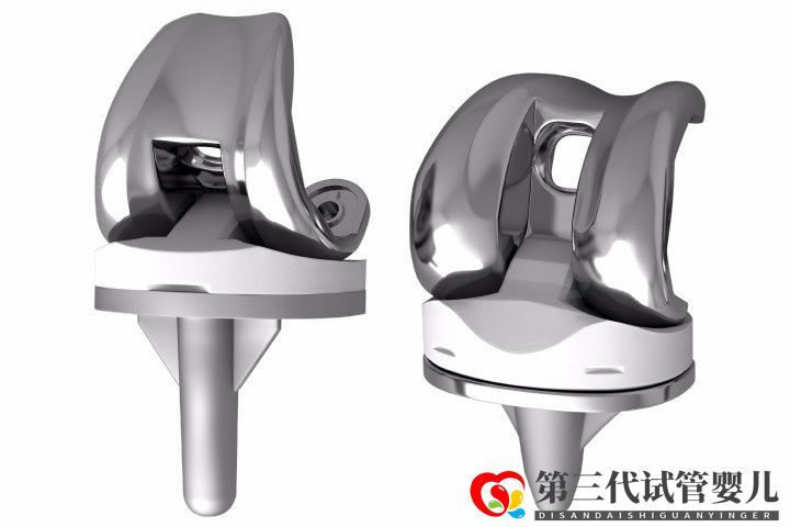 人工膝關節(jié)置換手術成功率大嗎？膝關節(jié)置換手術成功率有多高？(圖1)