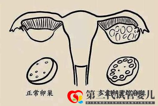 多囊促排懷孕成功率大嗎？(圖1)