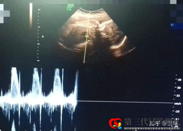 我終于懷上了辛酸三代試管經歷大家接好孕(圖4) 我終于懷上了辛酸三代試管經歷大家接好孕(圖4)