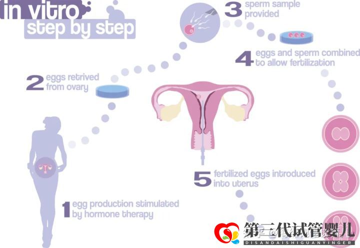 試管嬰兒1代、2代、3代、4代哪個最好真實操作過...(圖4)