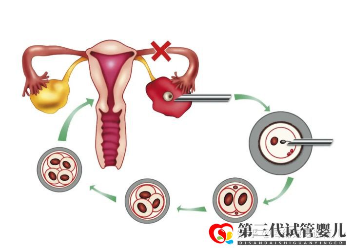 試管嬰兒1代、2代、3代、4代哪個最好真實操作過...(圖8)