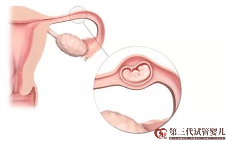 做試管嬰兒是不是可以避免宮外孕了？醫(yī)生告訴你沒那么簡單！(圖1)