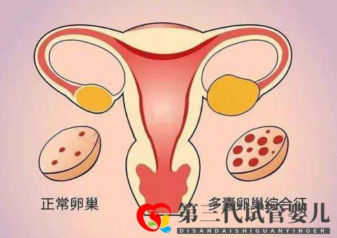 滔滔顧問(wèn)：試管取卵后怎么解決卵巢過(guò)度刺激綜合癥(圖1)