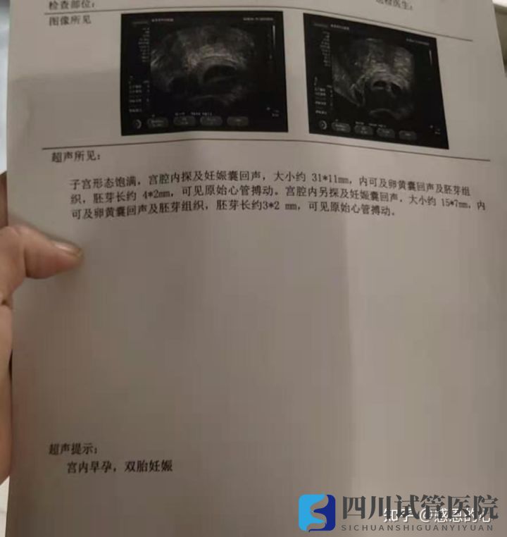 我在成都做三代試管的經(jīng)歷(標圖接好孕)(圖4) 我在成都做三代試管的經(jīng)歷(標圖接好孕)(圖4)